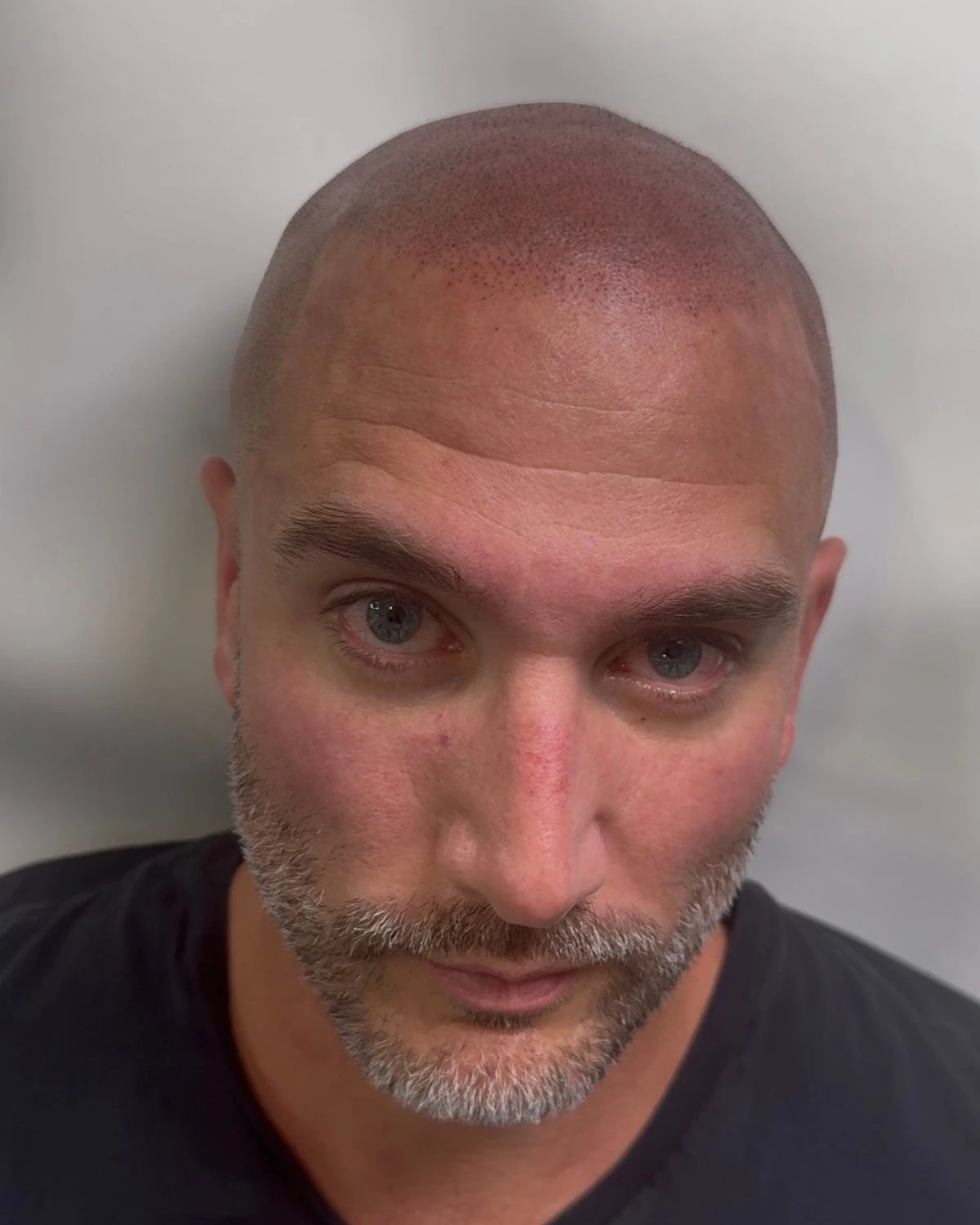 AFTER Scalp Micropigmentation result by Bik Shrestha at Brow Lady near Boston